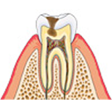 虫歯のイメージ