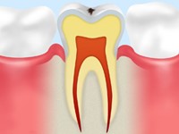 虫歯の症状-CO