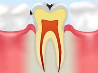 虫歯の症状-C1