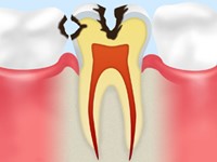虫歯の症状-C2