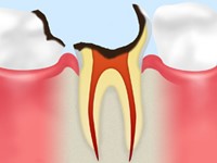 虫歯の症状-C4