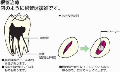 根管治療の図