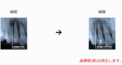 根管治療の図